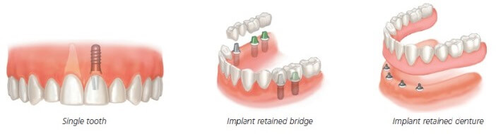 Dental Implants Options: Single tooth, several teeth or complete set of dentures.