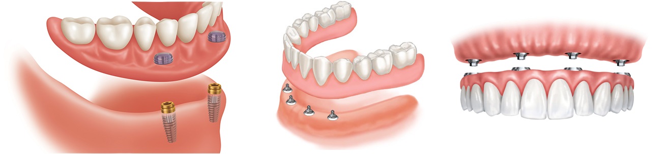 Image showing how dental implants can be 2 screws or more.