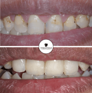 Veneers by streatfield dentists, Harrow, Middlesex