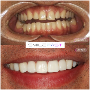 smile fast before and after: Book your free online cosmetic traetment consultation