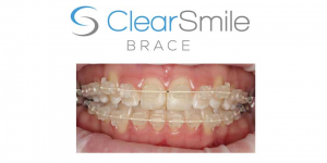 Clear Smile Braces for straight tee