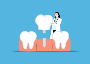 Tooth implant as an option for tooth replacement.